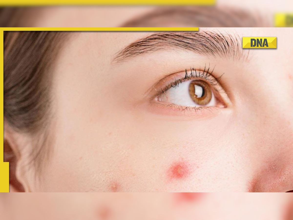 Skincare: know the difference between acne and pimples