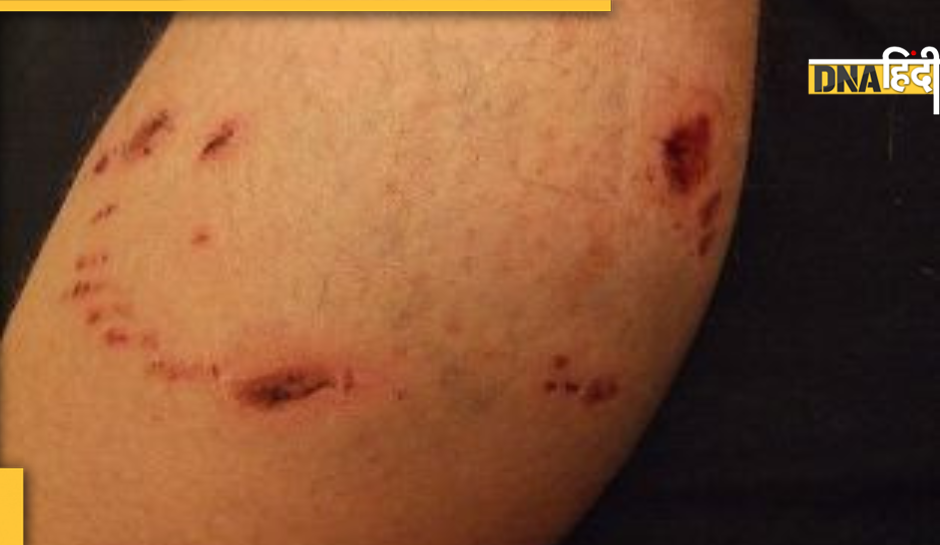 Dog bite home treatment in hindi hot sale