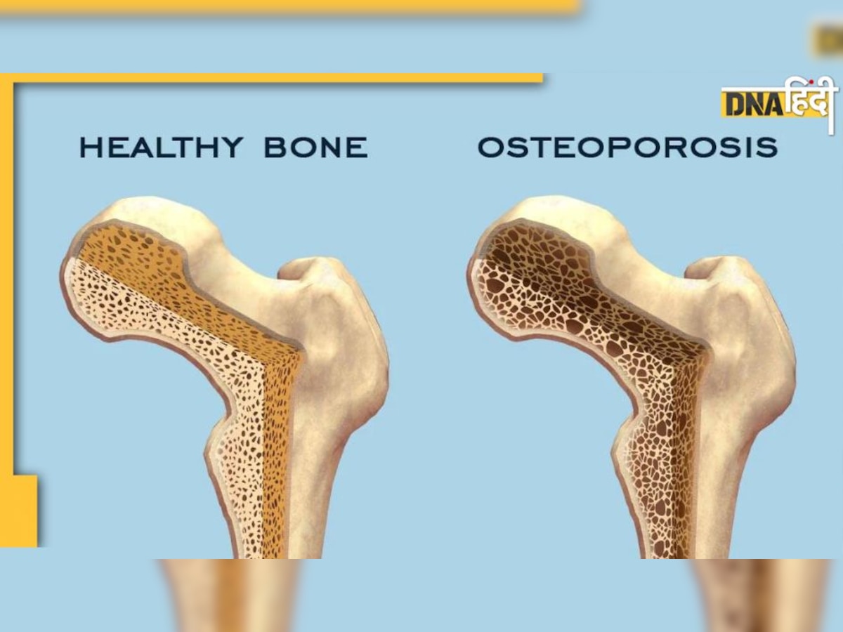 World Osteoporosis Day 2022: इस बीमारी में खोखली हो जाती हैं हड्डियां, छींकने से भी हो सकता है फ्रैक्चर