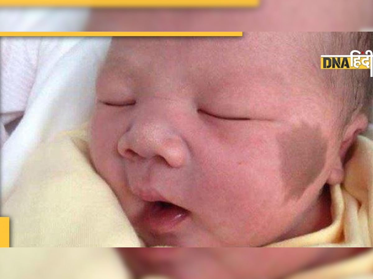 Child birthmark : क्या है बच्चों में Hemangiomas की बीमारी, कैसे बड़ी होती है और क्या है इलाज 