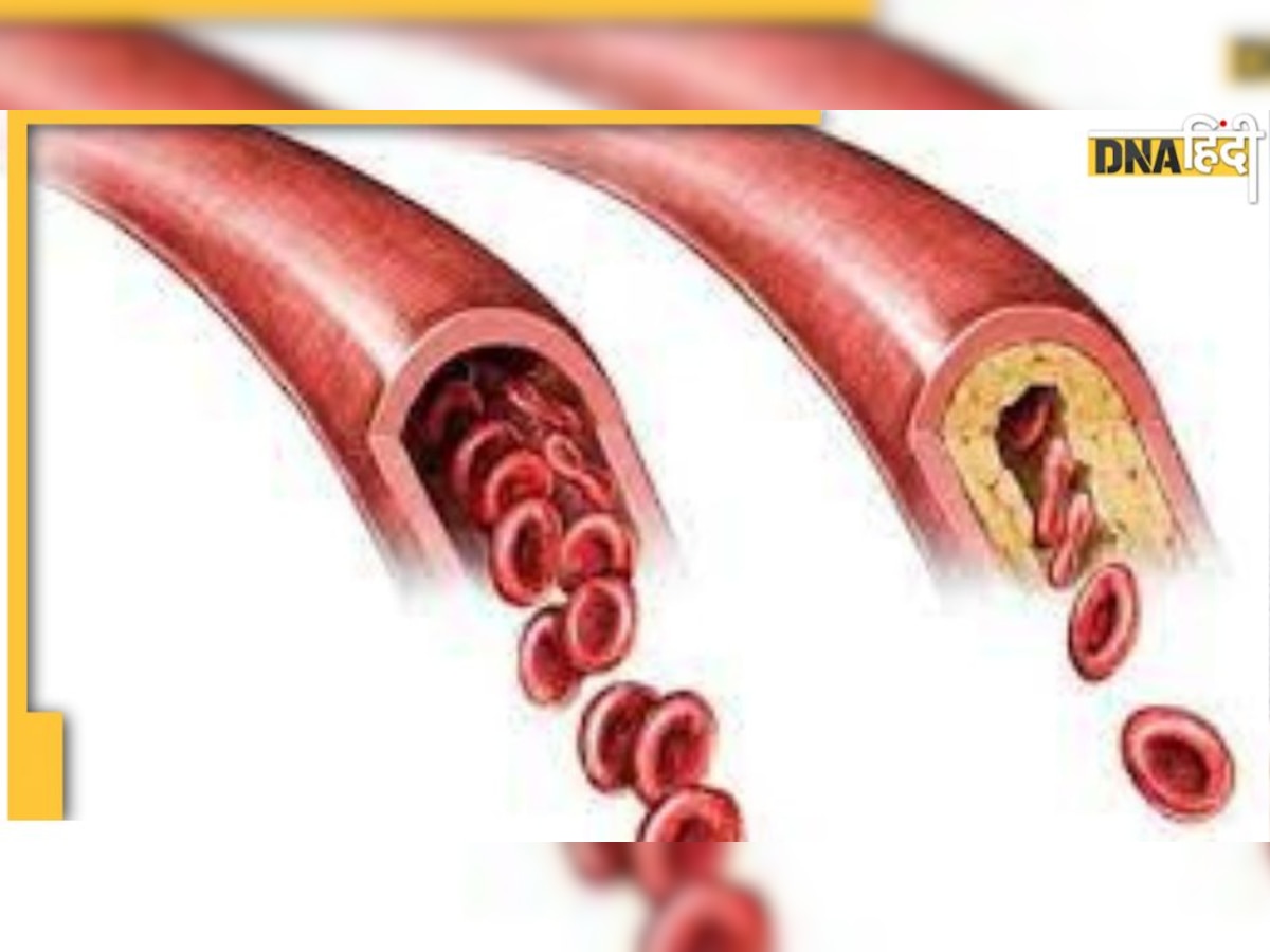 B12 deficiency : इस विटामिन की कमी से सिकुड़ जाती हैं धमनियां, हाई कोलेस्ट्रॉल वाले सतर्क रहें