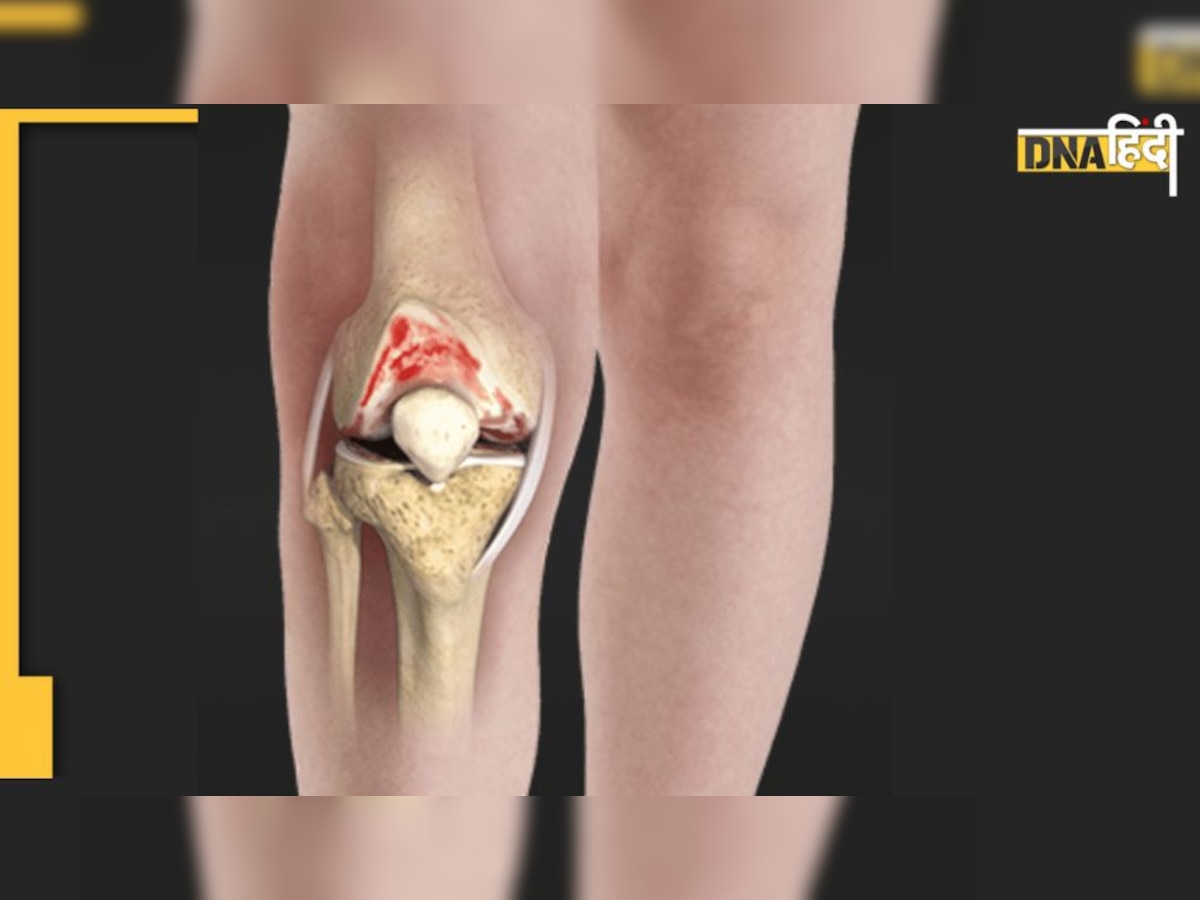 Knee Pain: घुटने के दर्द के लिए रामबाण हैं ये हीलिंग हर्ब्स, खून से निकल जाएगा यूरिक एसिड 