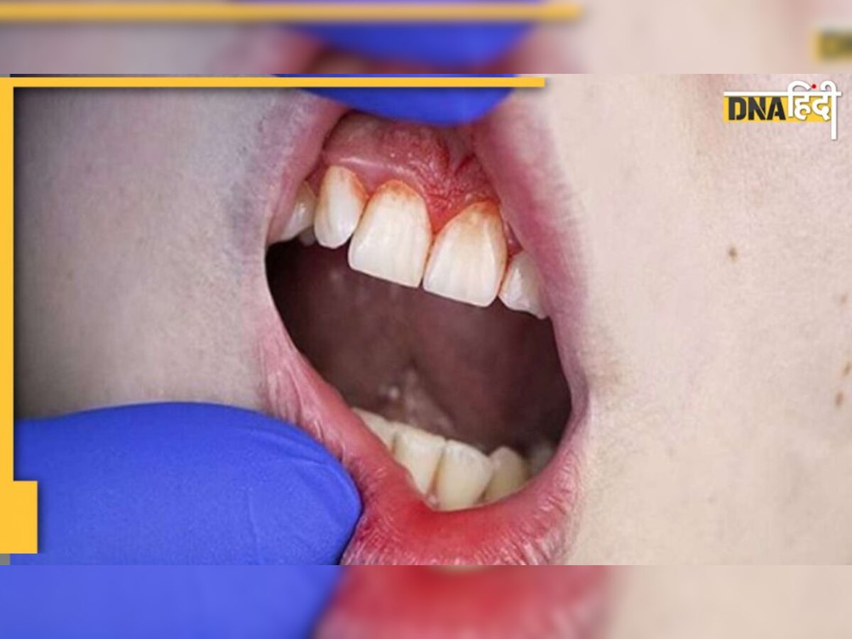 Mouth Disease: बासी मुंह चबा लें ये 5 पत्ते, दांत और मसूड़े से जुड़ी हर समस्या होगी दूर