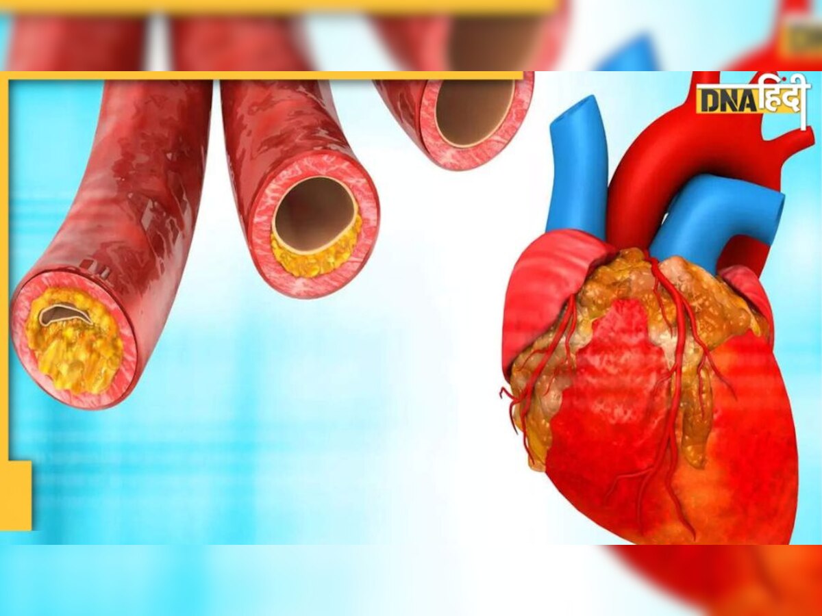 Cholesterol Cure : नहीं पिघल रही नसों में जमी वसा? इस बीज से दूर होगी समस्या