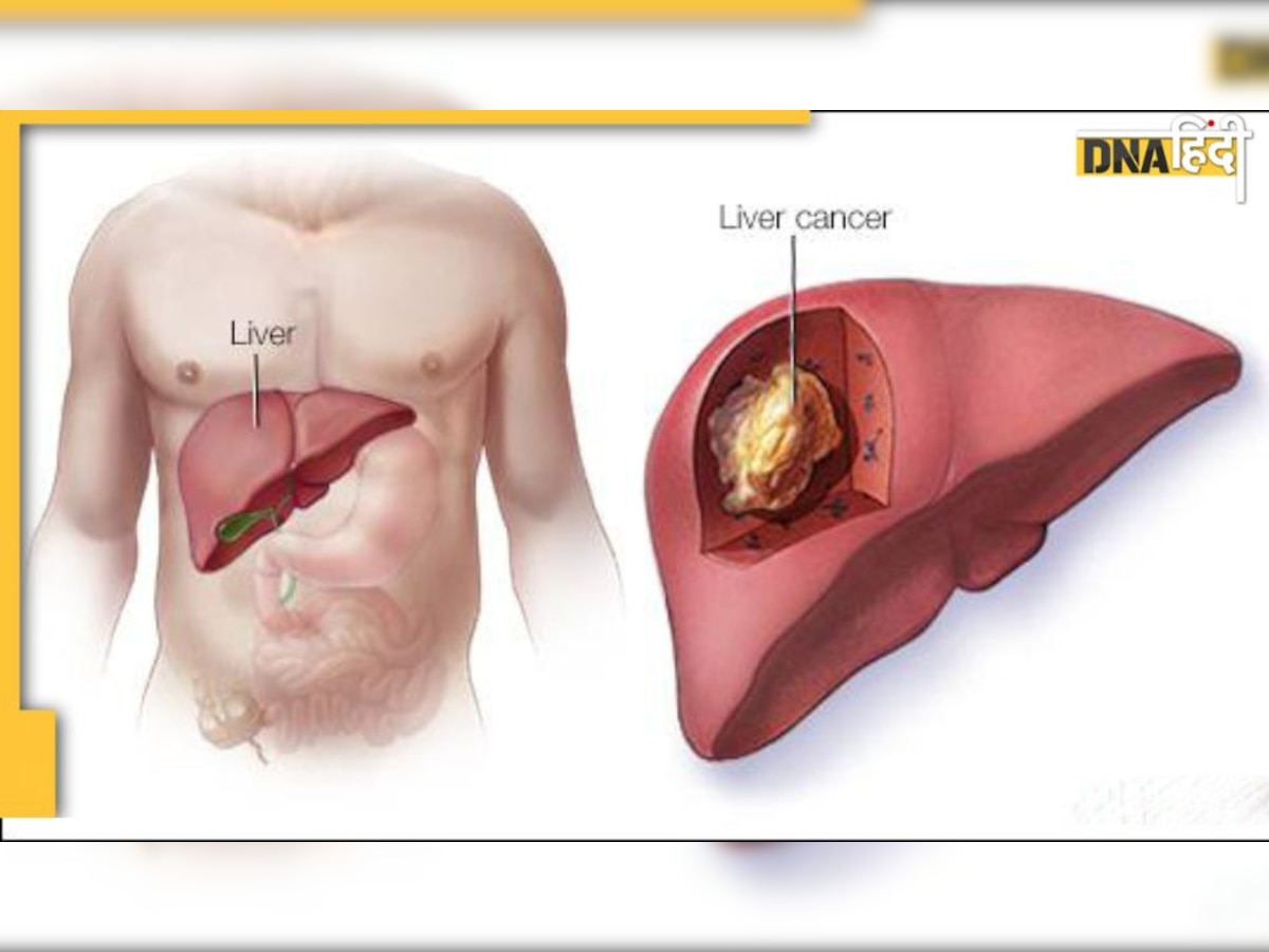 Liver Cancer Symptoms: इन कारणों से हो सकता है लिवर कैंसर, ऐसे करें बचाव