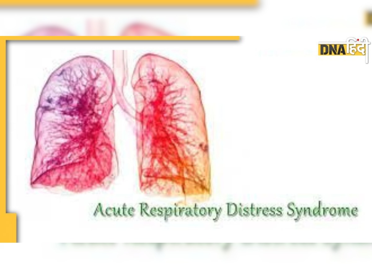 Lungs Disease: फेफड़ों को भी लगता है शॉक, कोरोना संक्रमितों में बढ़ रहा एक्यूट रेस्पिरेटरी डिस्ट्रेस सिंड्रोम