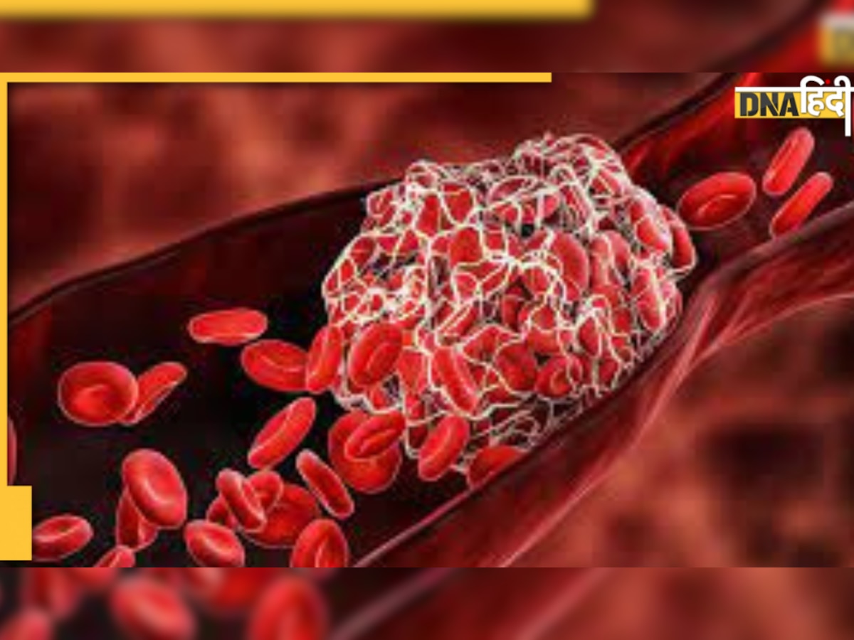 Blood Clot: नसों में बन रहे खून के थक्के, इन लक्षणों से पहचानें और तुरंत करें उपाय