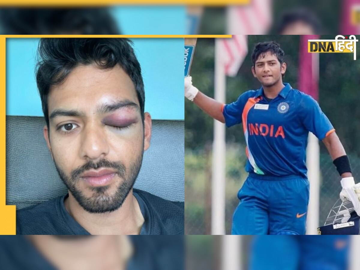 Unmukt Chand eye injury: पूर्व क्रिकेटर उनमुक्त चंद की आंख में लगी भयानक चोट, चेहरे का हुआ ऐसा हाल