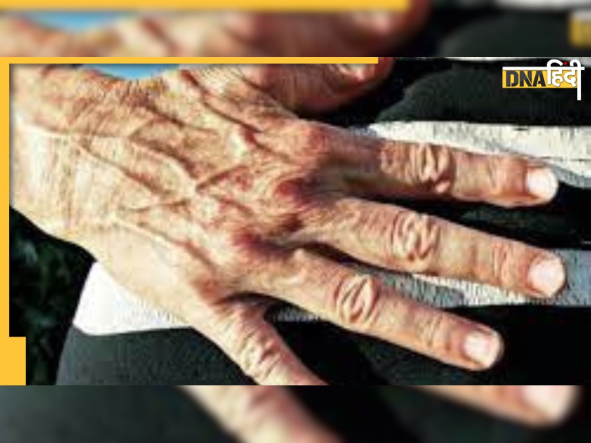 Visible Veins: हाथ या पैरों में नसों का फूलकर दिखाई देना, ये हो सकती हैं वजह 