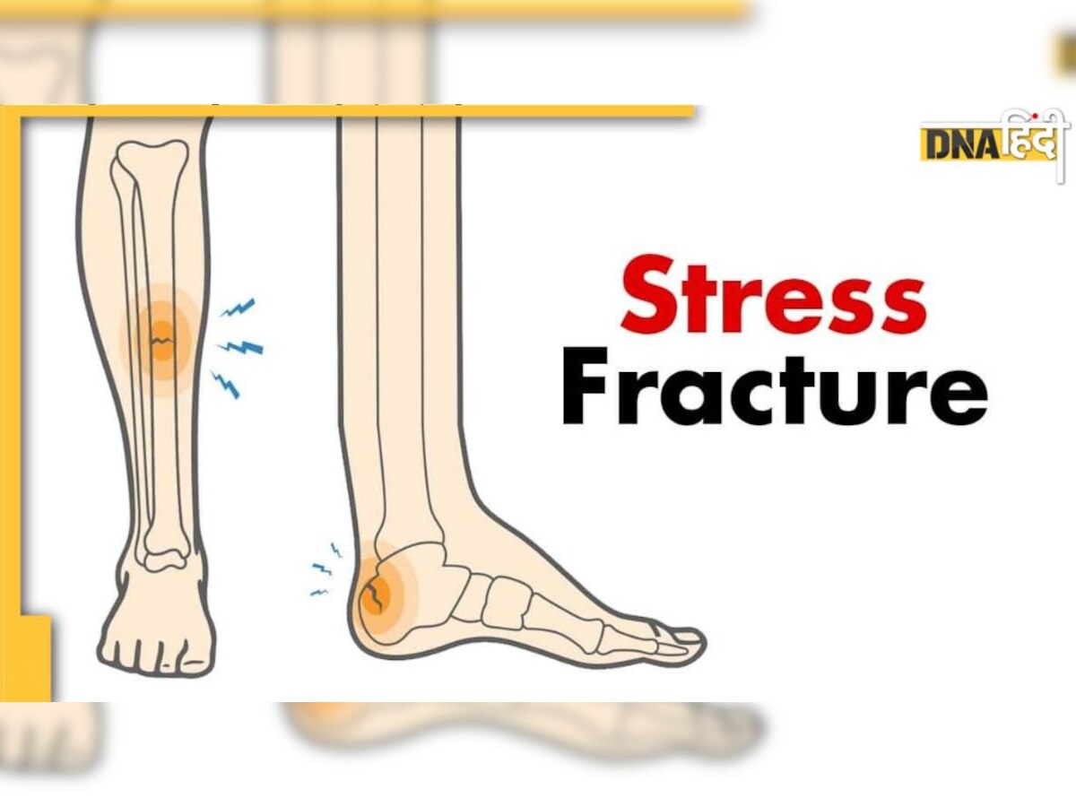 Stress Fracture: स्ट्रेस फ्रेक्चर बना सकता है अपाहिज, क्रिकेटर बुमराह भी झेल रहे ये दर्द, जानिए इसके खतरे