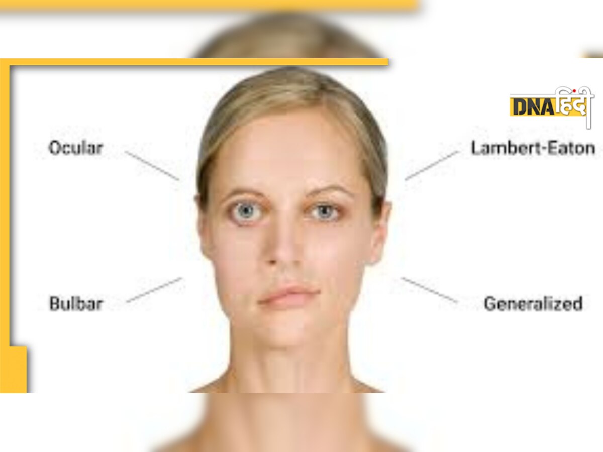 Myasthenia Gravis Symptoms: एक्टर अरुण बाली को थी यह रेयर बीमारी, क्या हैं लक्षण और इलाज