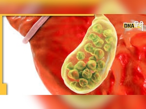 Gallstone Symptoms: पेट के ऊपरी हिस्से में दर्द गैस तो नहीं, फिर क्या पथरी के हैं लक्षण, ऐसे पहचानें 
