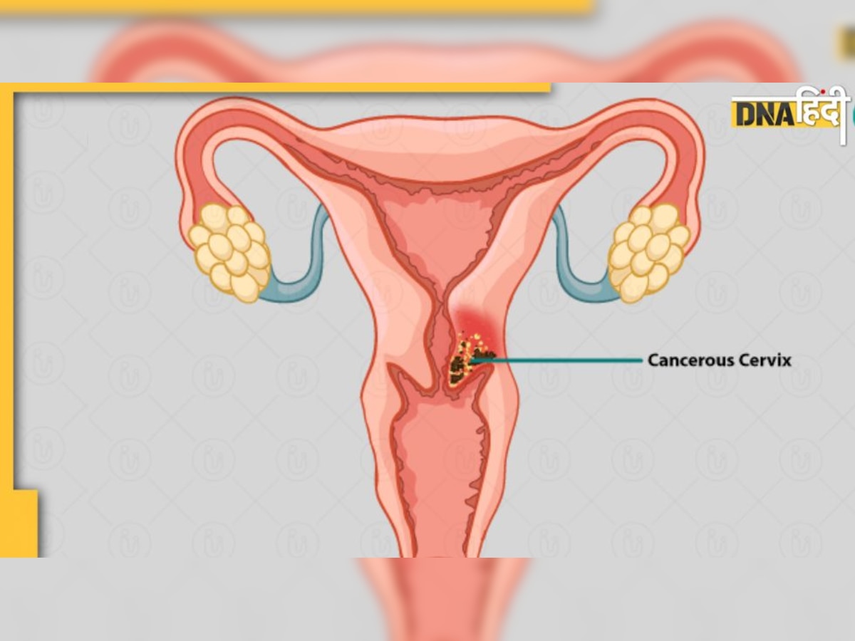 Cervical Cancer Cure: माइक्रो आरएन से होगा सर्वाइकल कैंसर का इलाज, बीएचयू के वैज्ञानिकों ने खोजी यह थेरेपी