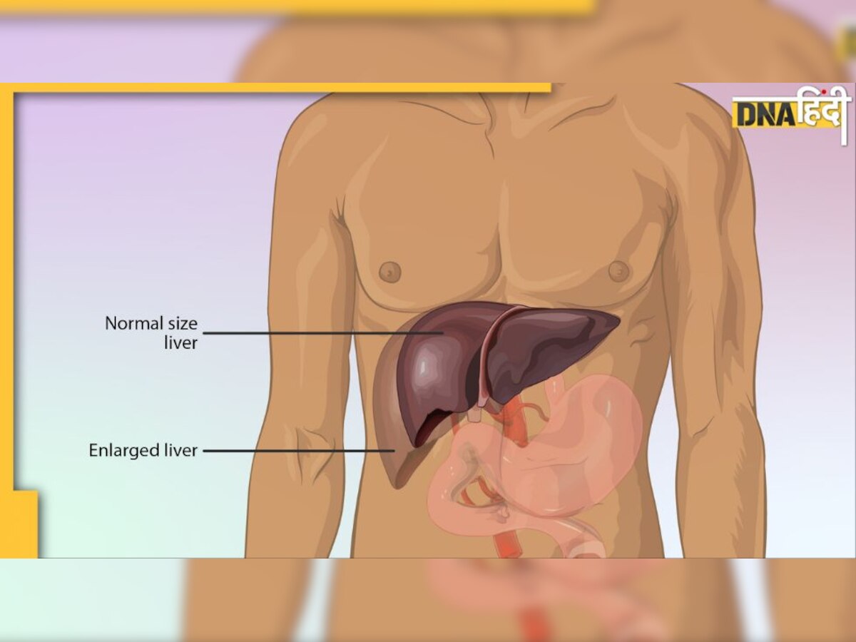 Fatty Liver Disease: लिवर पर जम गया है फैट? ये 6 चीजें गंदगी समेत पेट की चर्बी भी पिघाला देंगी