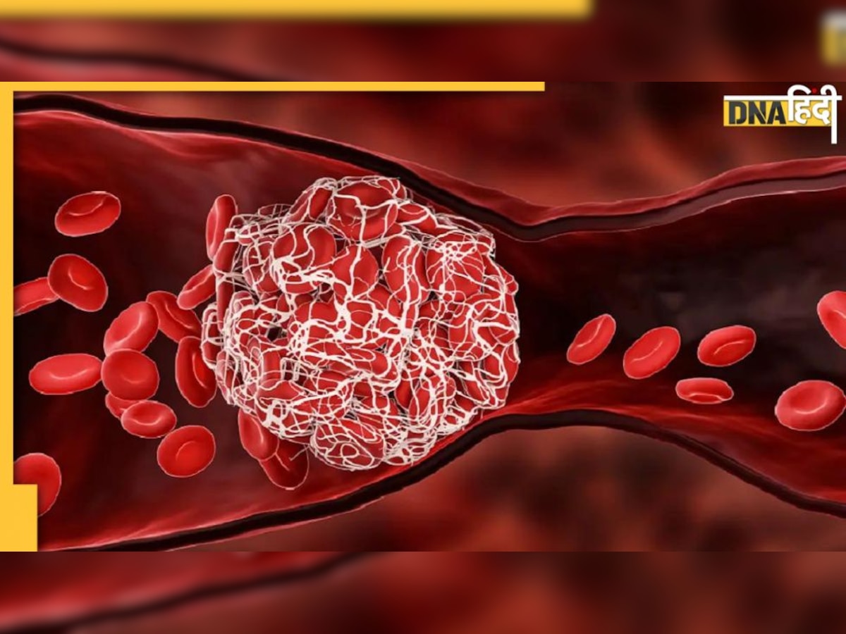 Blood Clots Sign: नसों में खून के थक्कों को पिघला देंगे ये आयुर्वेदिक नुस्खे, ऐसे जानें गाढ़ा हो रहा ब्लड