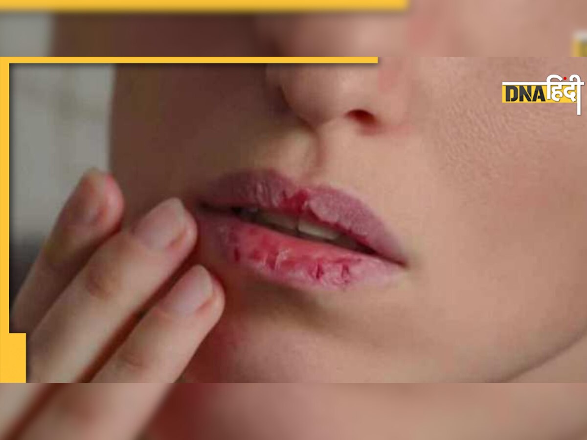 Chapped Lips Home Remedies: फटे होंठ पर जब न आए कोई उपाय काम, तो ये टिप्स दिलाएंगे तुरंत आराम