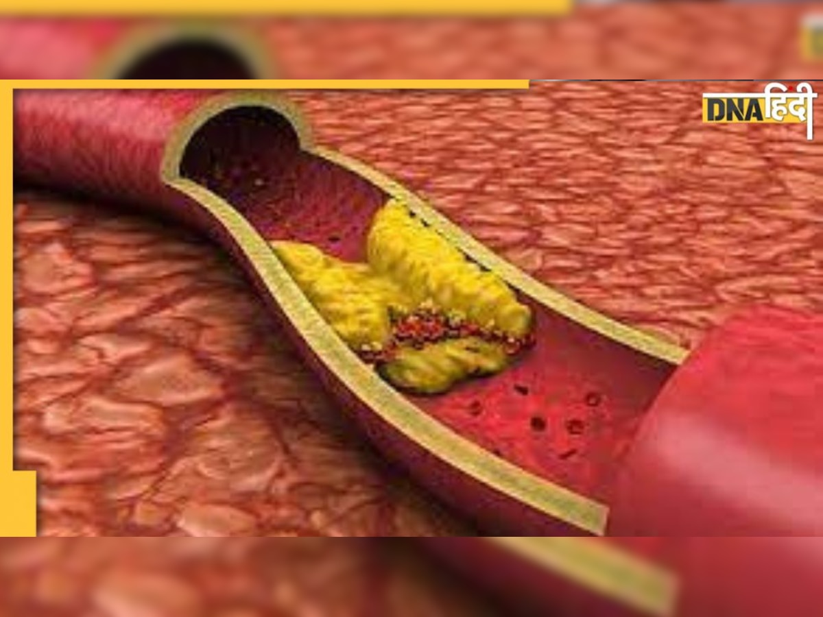 Cholesterol : नसों में जमी वसा को मोम की तरह पिघला देंगी ये 8 चीजें, टल जाएगा ठंड में हार्ट अटैक-स्ट्रोक का खतरा