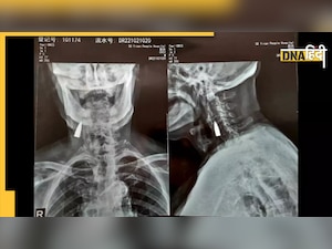 77 साल तक सैनिक के गले की हड्डी में अटकी रही गोली, एक्स-रे में हुआ खुलासा