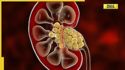 Avoid these 5 things from your diet if you have kidney stones