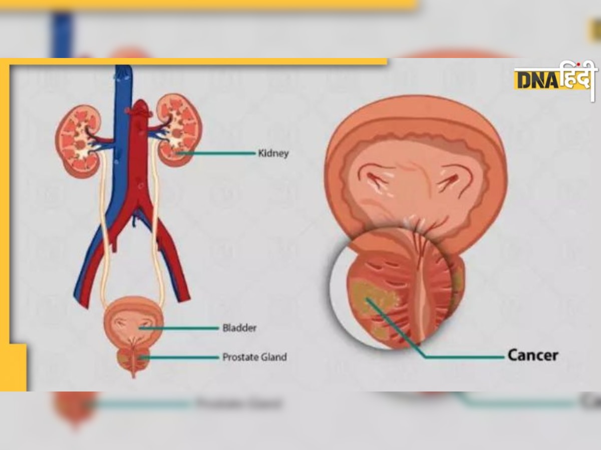 Prostate Cancer: ब्लड में इस प्रोटीन के हाई होने से बढ़ता है पुरुषों में प्रोस्टेट कैंसर का खतरा, ये लक्��षण नजर आते कराएं जांच 