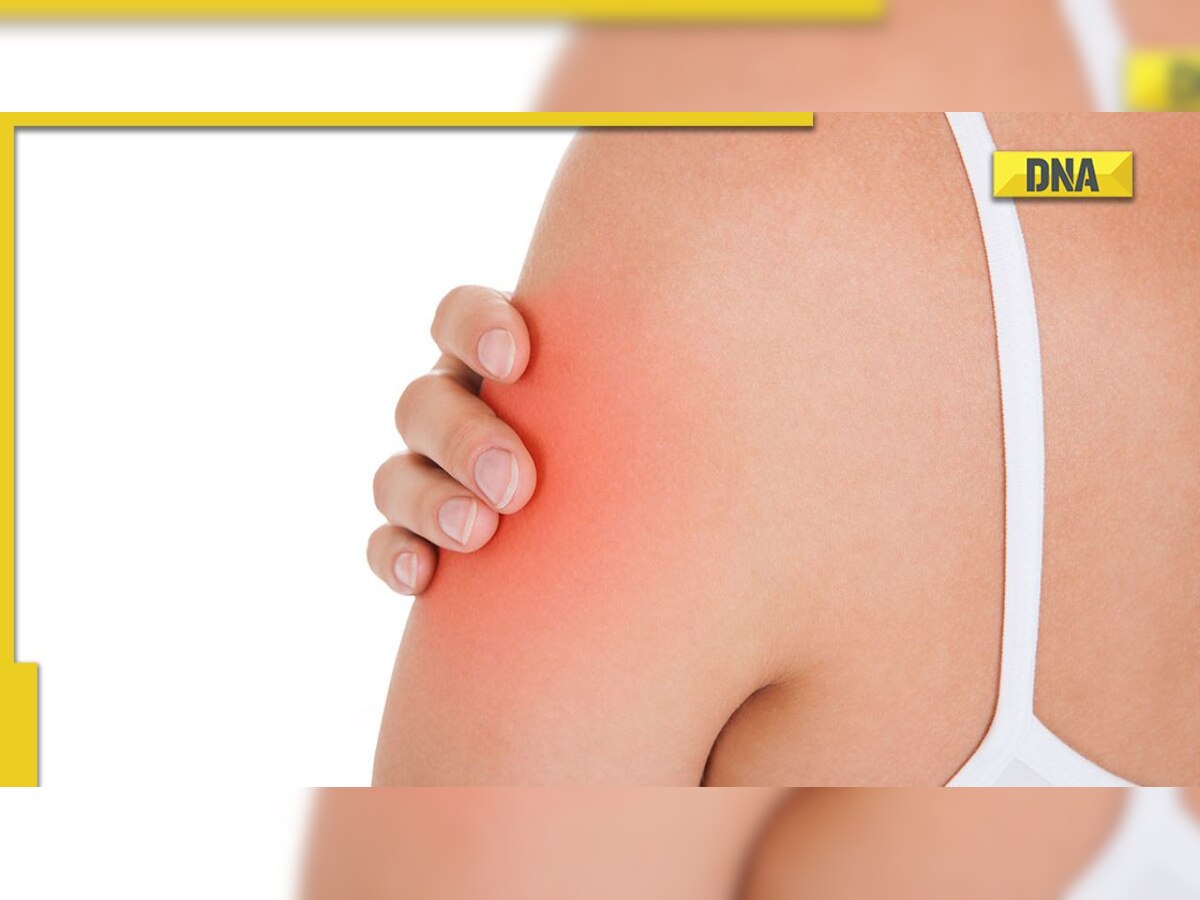 What is Covid arm? Here's everything you need to know