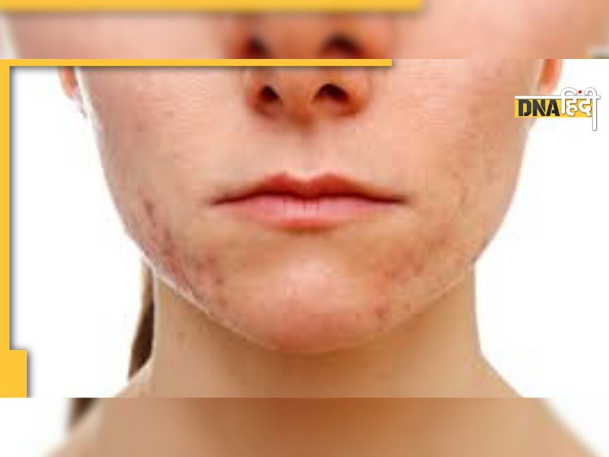 Hormonal Acne: 20-40 की महिलाओं के स्किन में दिखते हैं ये बदलाव,  लक्षण और इलाज