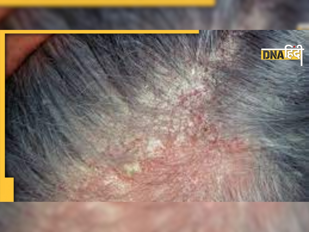 Scalp Eczema: कई कारणों से सिर की त्वचा से निकलने लगती है परत, तुरंत इन बातों को गौर करें 