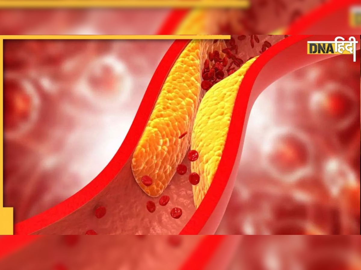 Cholesterol : नसाें में जम चुकी वसा और गंदगी को दूर कर देंगे ये फूड्स, मोम की तरह पिघलेगी चर्बी