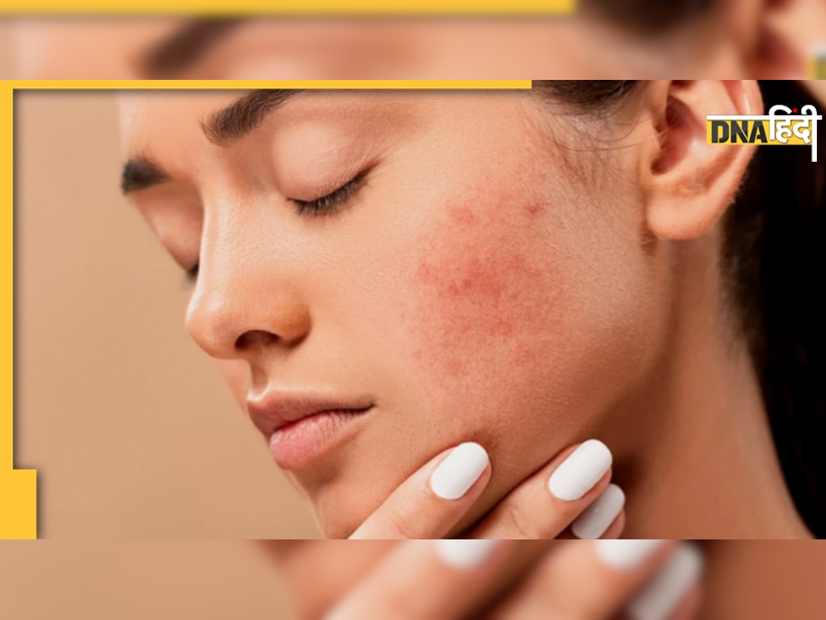 Remedies For Pigmentation: इन होममेड फेस पैक से चेहरे की जिद्दी झाइयां होंगी दूर, ये है बनाने का तरीका