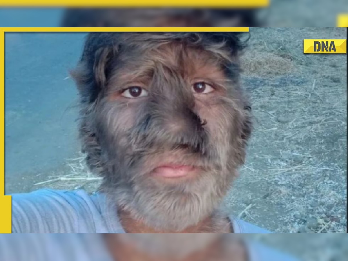 Madhya Pradesh: Teenager suffering from rare 'werewolf syndrome' speaks up on getting bullied at school