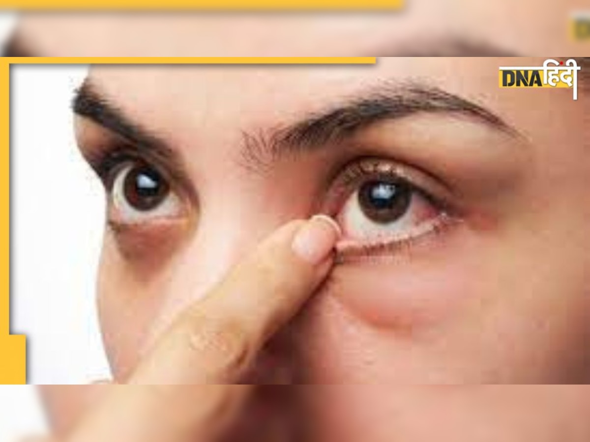 Diabetes Sign In eyes: आंखों में दिखने वाली ये गंभीर बीमारी ब्लड शुगर अनकंट्रोल होने का है संकेत