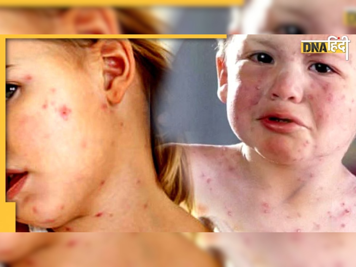 Diet in Measles: खसरा पीड़ित बच्चे की देखभाल कैसे करें? विटामिन ए और सी रिच डाइट रैशेज को करेगी कम