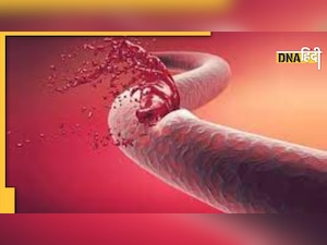 Hemophilia: क्या है हीमोफीलिया की बीमारी, जिसके इलाज में पूरी जिंदगी में खर्च हो जाते हैं 100 करोड़ से ज्यादा 