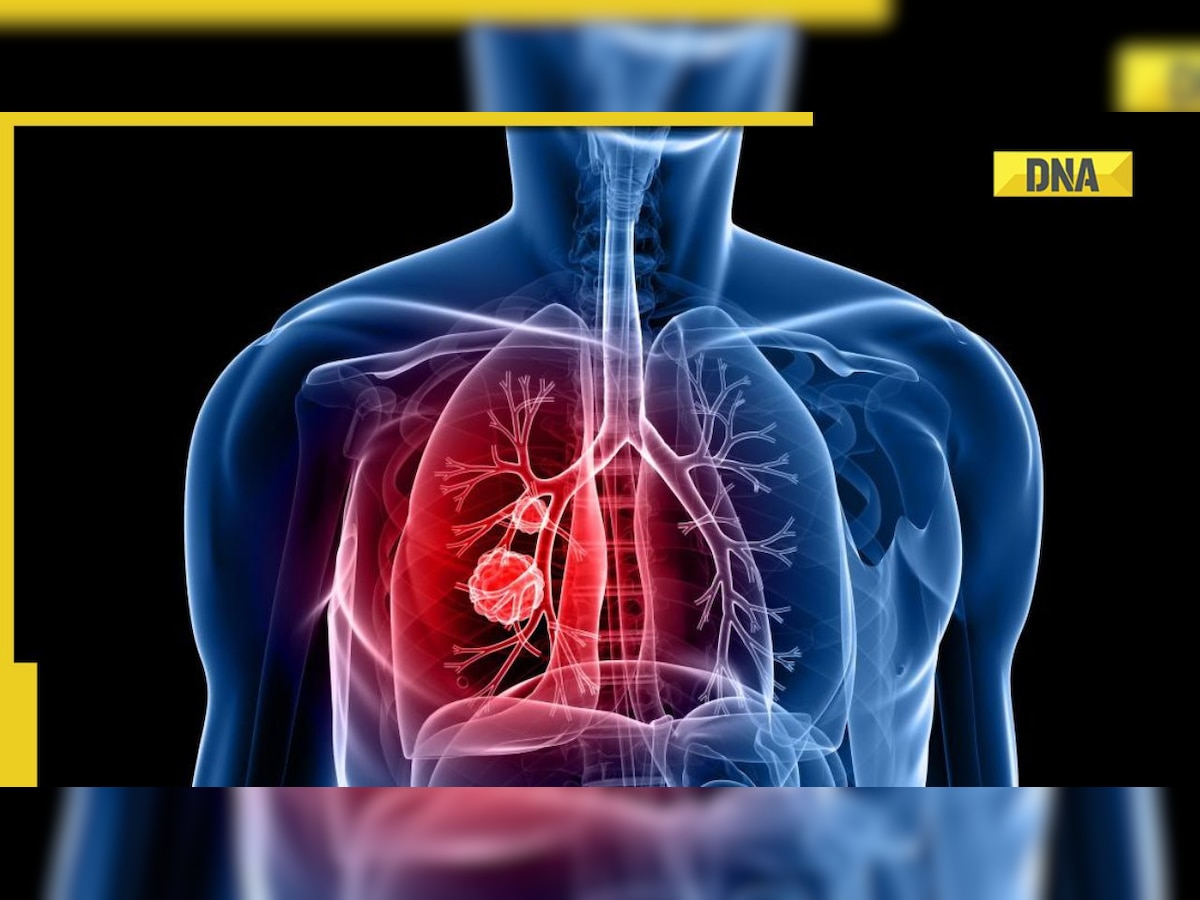Lung cancer: Cause, remedies, prevention here 