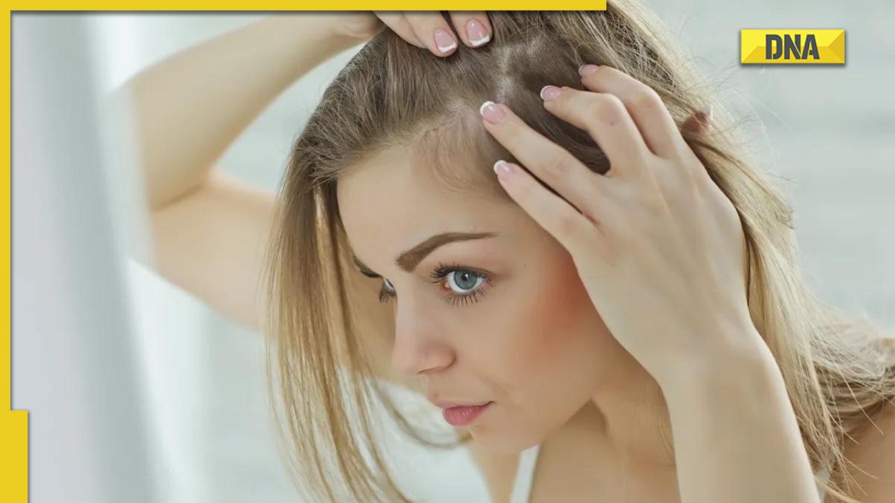 Hair fall 5 foods to prevent hair loss