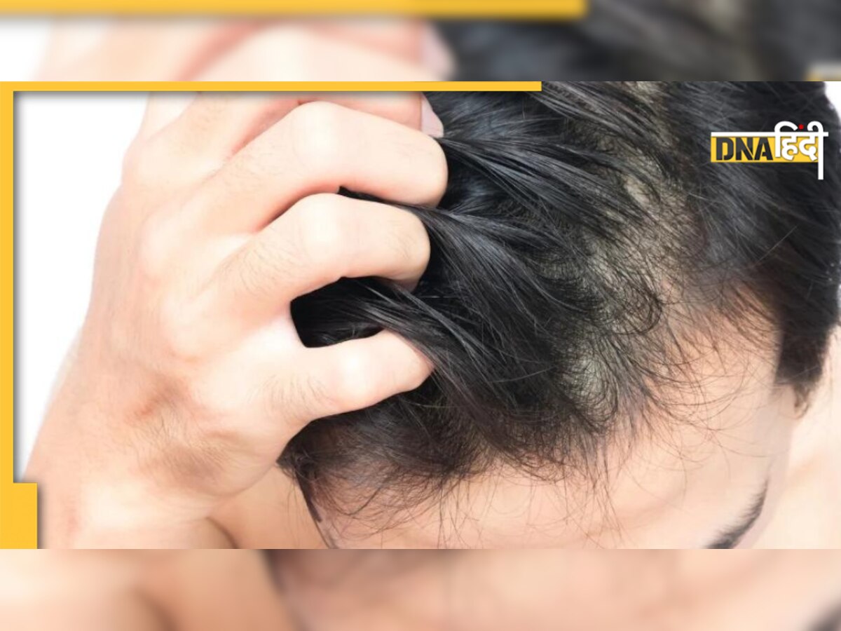 Hair Itching Tips: सर्दियों में बालों की खुजली से हैं परेशान, इन घरेलू उपाय से मिलेगा छुटकारा