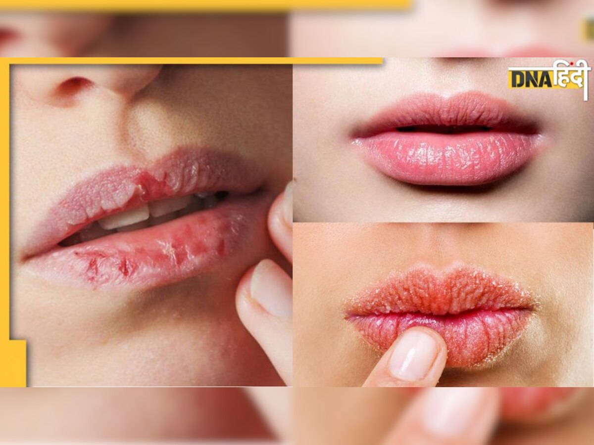 Chapped Lips Cure: कटे-फटे होंठ मिनटों में बन जाएंगे नर्म और गुलाबी, घर पर बना लें ये हर्बल लिप बाम