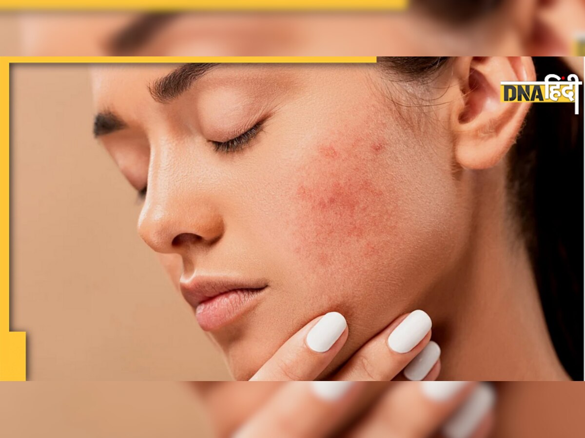 Rosacea Disease: चेहरे पर दिखने वाले ये लाल निशान हैं गंभीर बीमारी का संकेत, नहीं किया केयर तो रह जाएंगे दाग