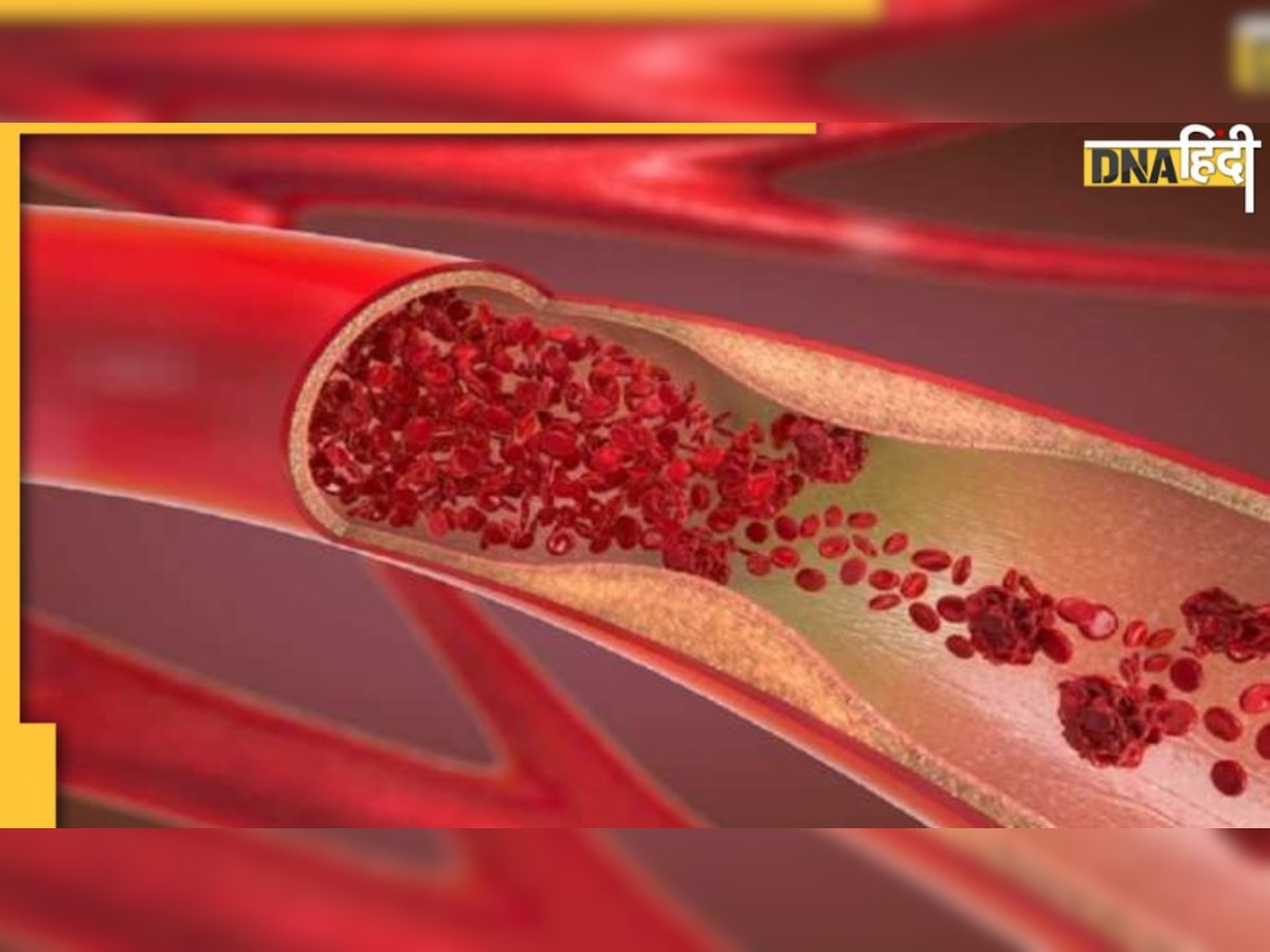 Stroke-Cardiac Arrest Sign: ये लक्षण बताते हैं नसों में है गंभीर ब्लॉकेज, कभी भी आ सकता है स्ट्रोक या हार्ट अट्रैक 