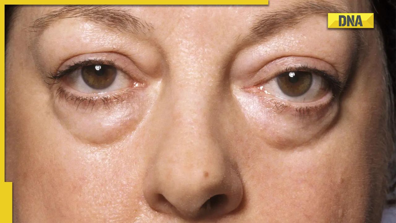 Under eye tear trough deformity in a mild case of thyroid eye disease   Download Scientific Diagram