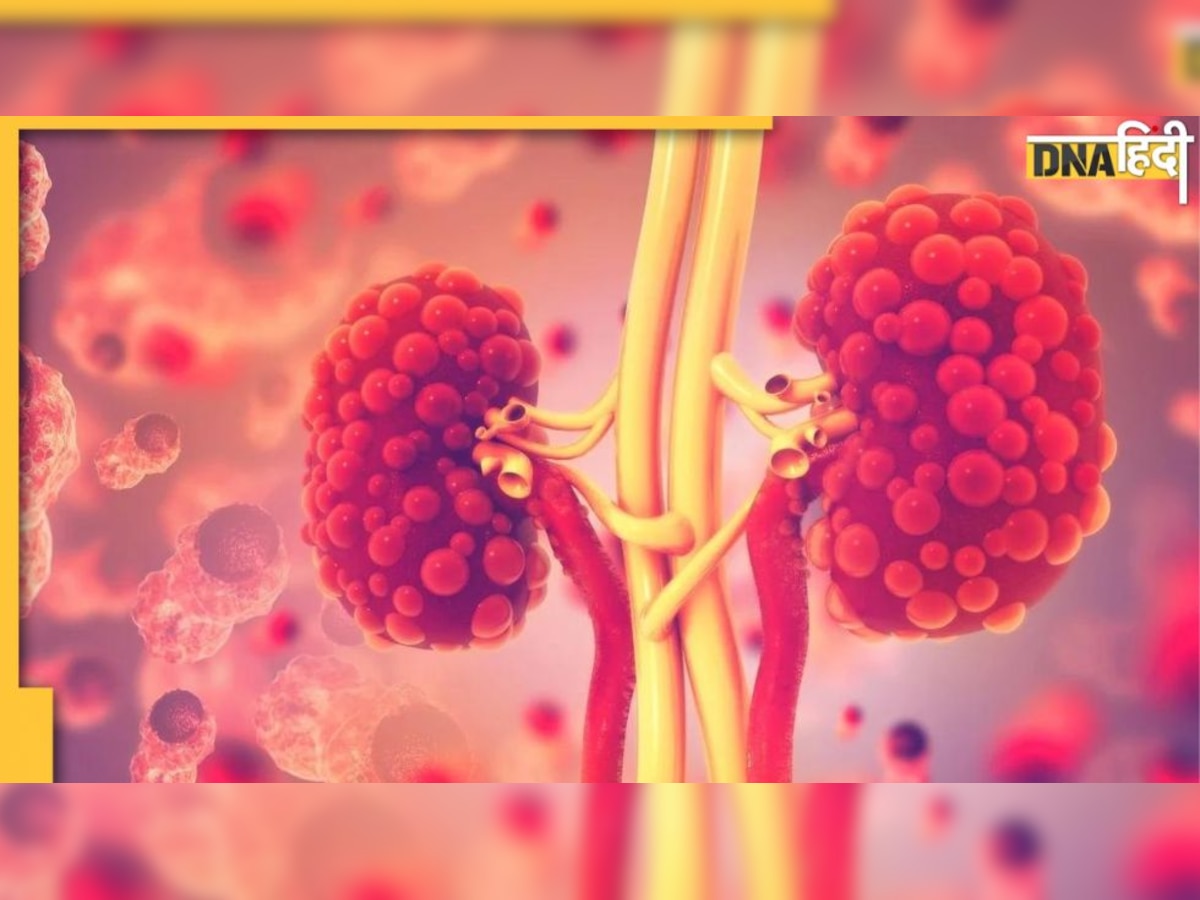 Blood Clots: किडनी में ब्लड क्लॉटिंग का इशारा हैं पेट मे दर्द से लेकर यूरिन में खून आने जैसे ये 6 लक्षण