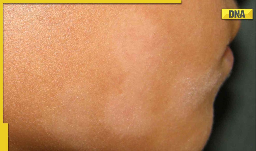 Vitamin Deficiencies Linked To white Spots On Face All You Need To Know vitamin-deficiencies-linked-to-white-spots-on-face-all-you-need-to-know