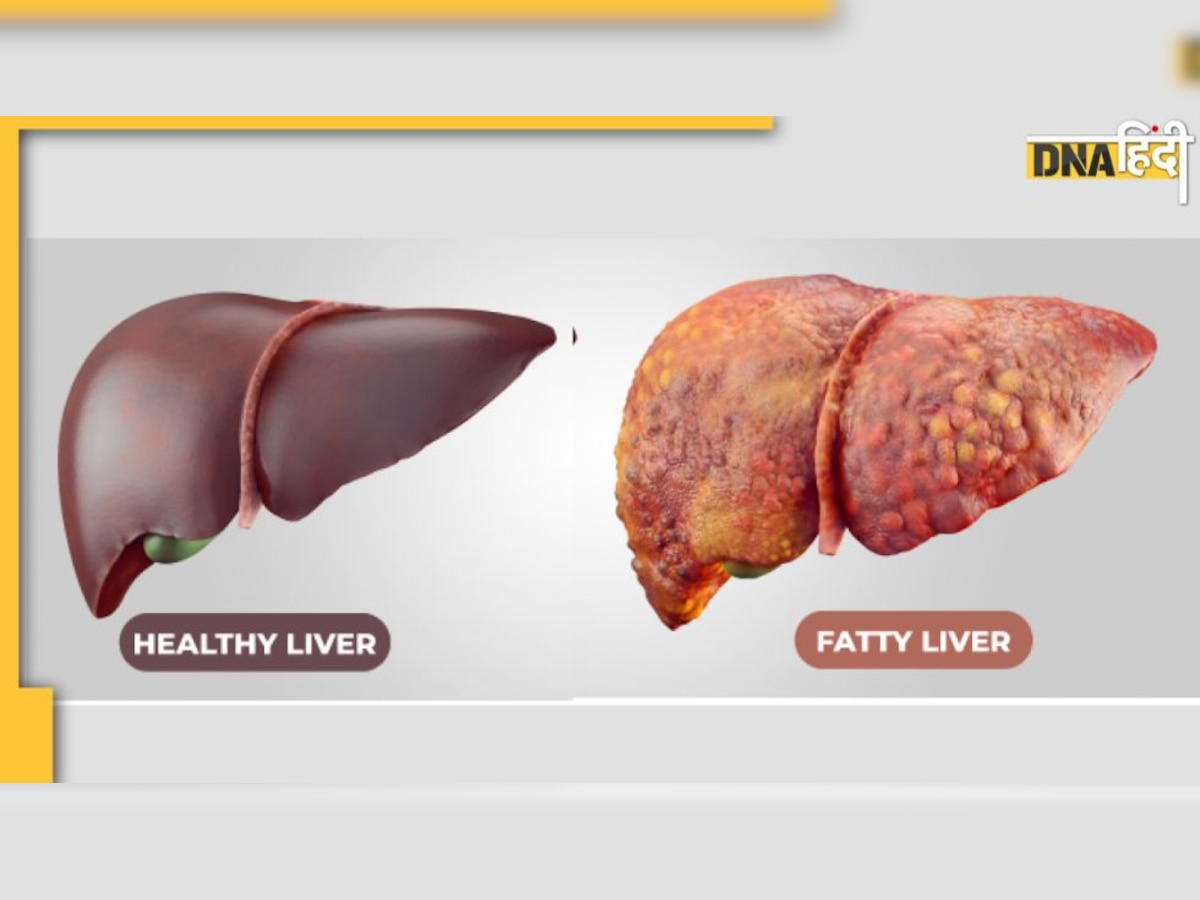 Liver Damage Sign: क्या रोज रात 1 से 4 बजे के बीच टूटती है आपकी नींद? लिवर डैमेज के हैं ये संकेत