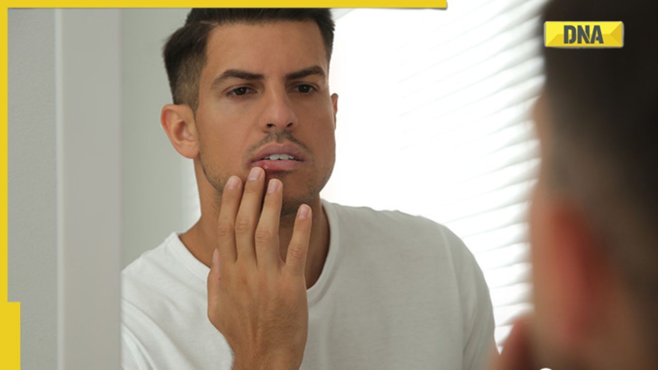 Mouth Ulcers 5 natural remedies to heal canker sores