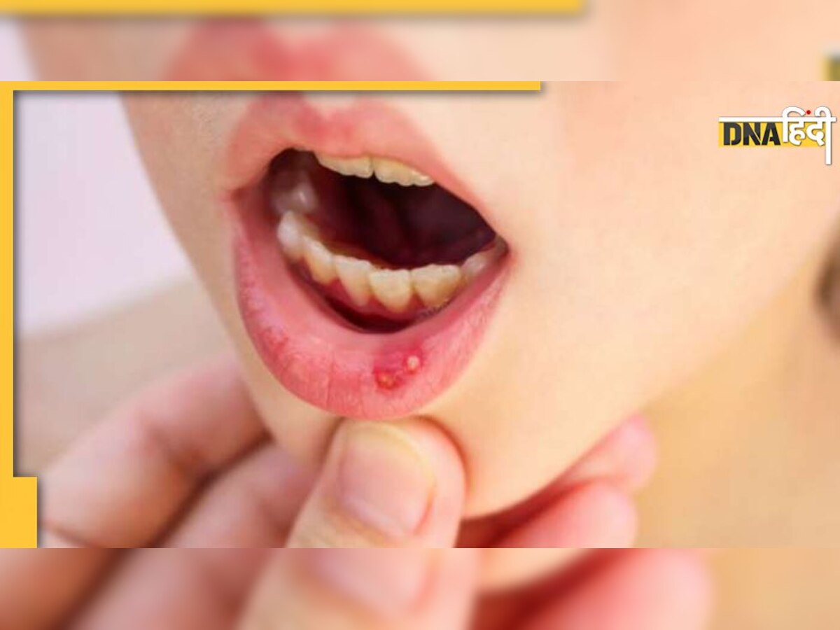 Mouth Ulcer Remedy: मुंह के छालों से हैं परेशान, इन देसी नुस्खों से तुरंत मिलेगा आराम