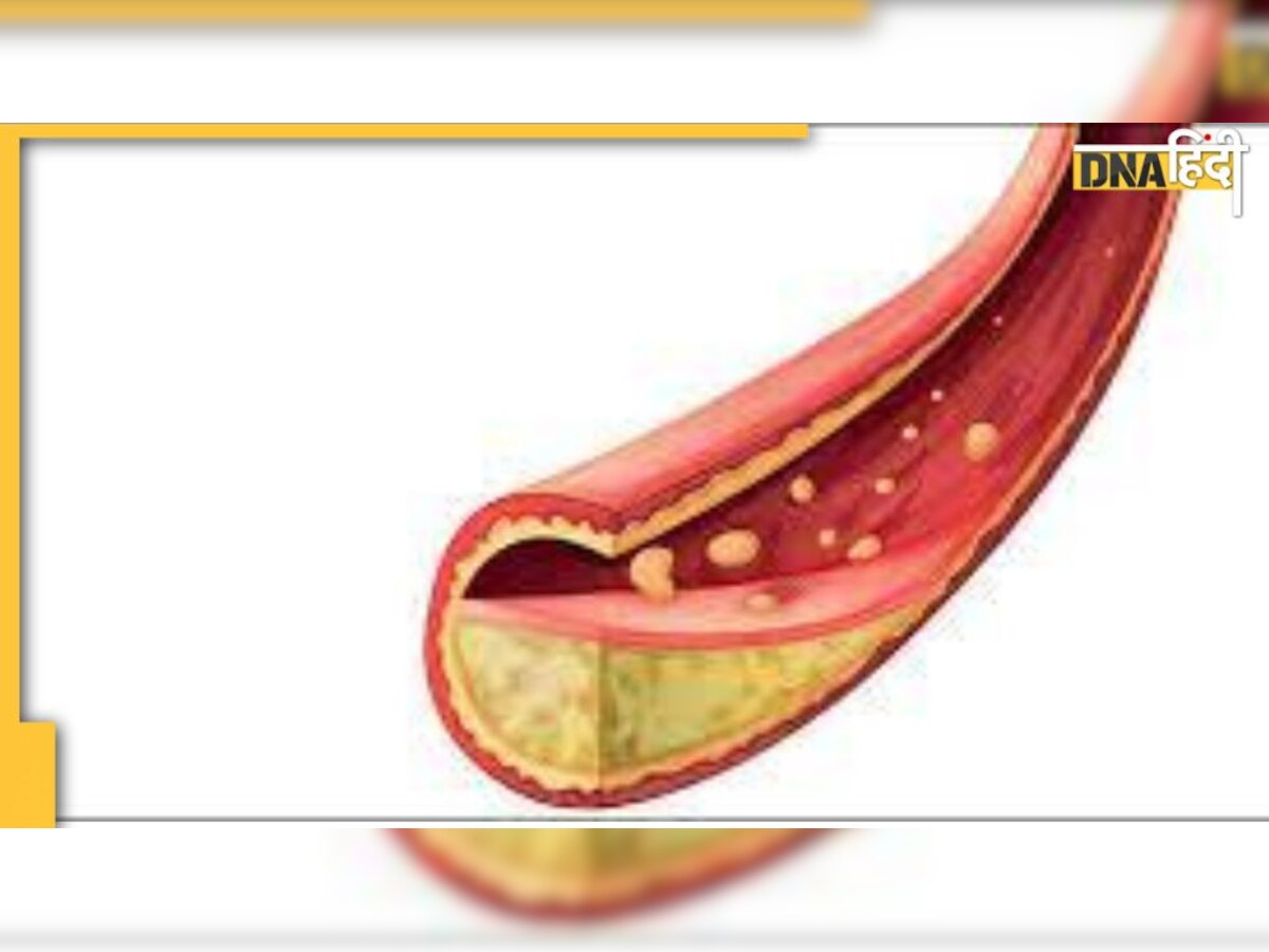 Clog Arteries: गंदगी भरकर नसों को ब्लॉक कर देती हैं ये 5 चीजें, बढ़ता है वेन्स के फटने का खतरा