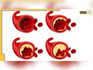 Bood Fat Loss: नसों में जमी वसा को निकालने के लिए रोज पीएं ये जेल, ब्लड से निकल जाएगा सारा गंदा कोलेस्ट्रॉल 