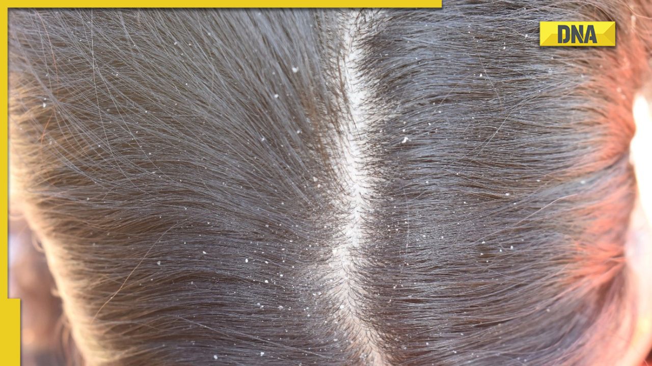 Haircare in winter: 5 effective home remedies to treat dandruff Haircare in winter: 5 effective home remedies to treat dandruff