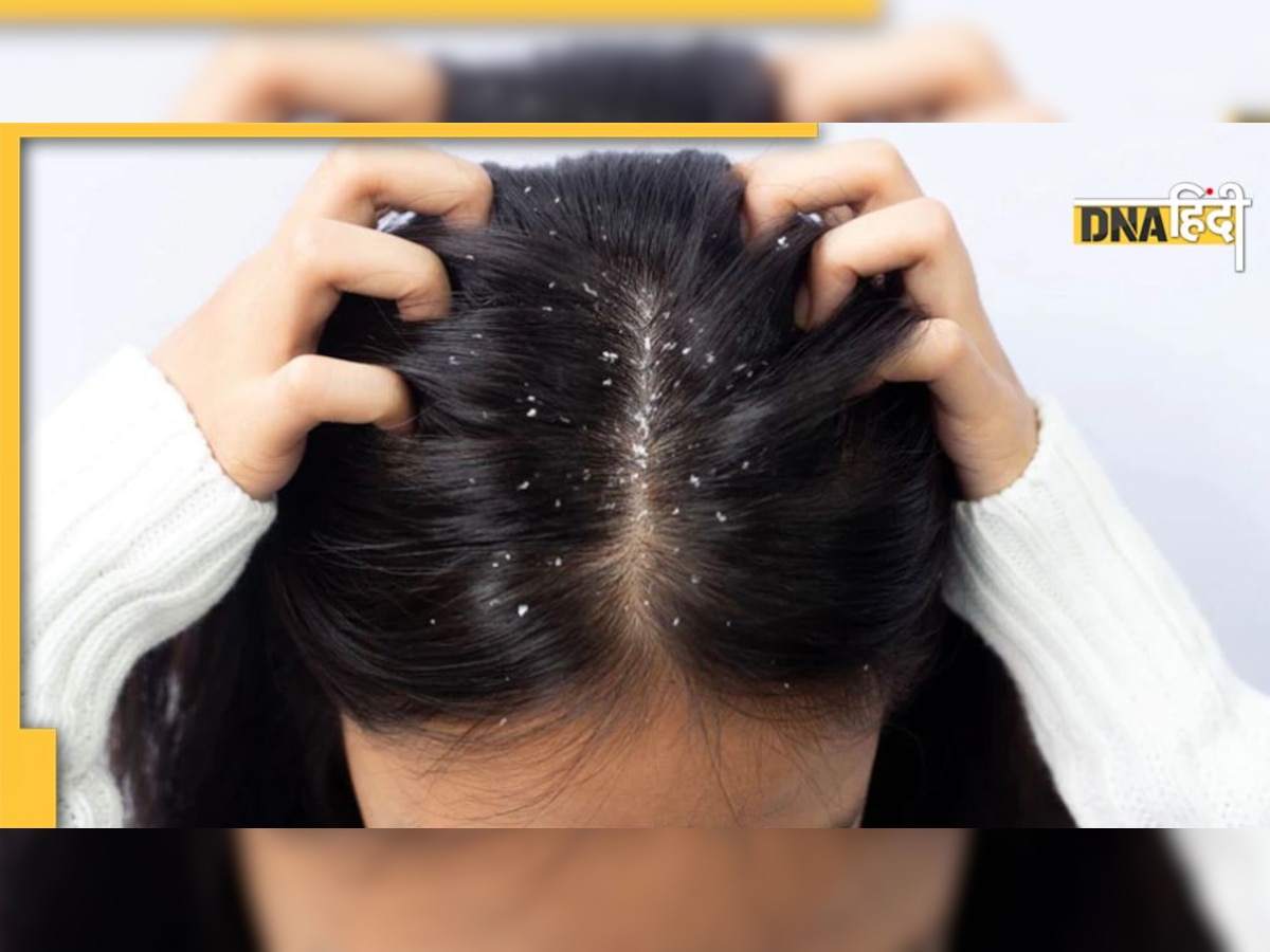 Dandruff Remedy: बालों में जमी डैंड्रफ की लेयर का रामबाण इलाज है ये नुस्खा, 3 दिन में गायब होगी रुसी