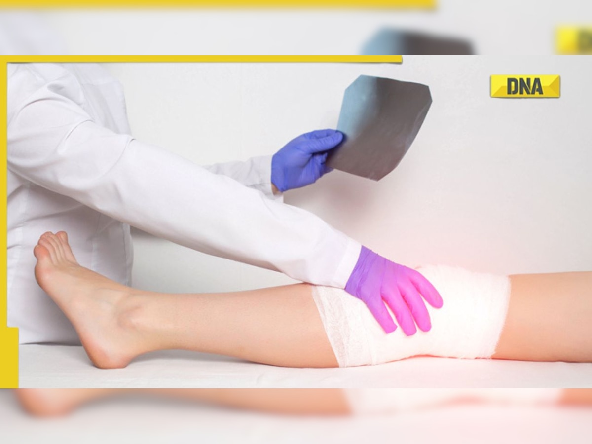 Suffering from ligament tear like cricketer Rishabh pant; know all about the recovery process